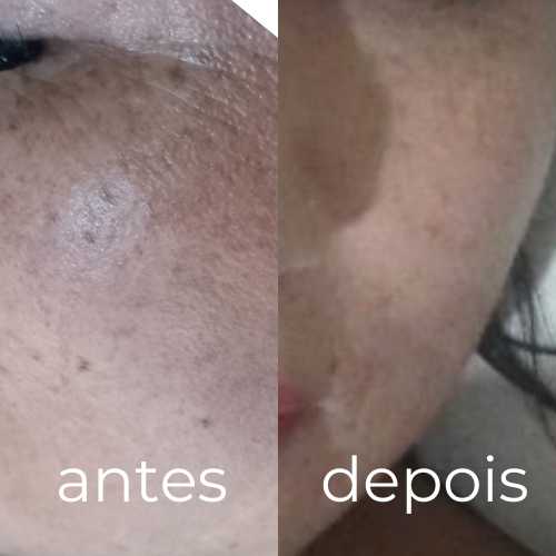 Tratamento para Melasma Clinica Cuervo