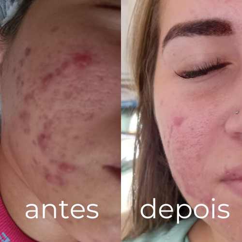 Tratamento para Acne Clinica Cuervo